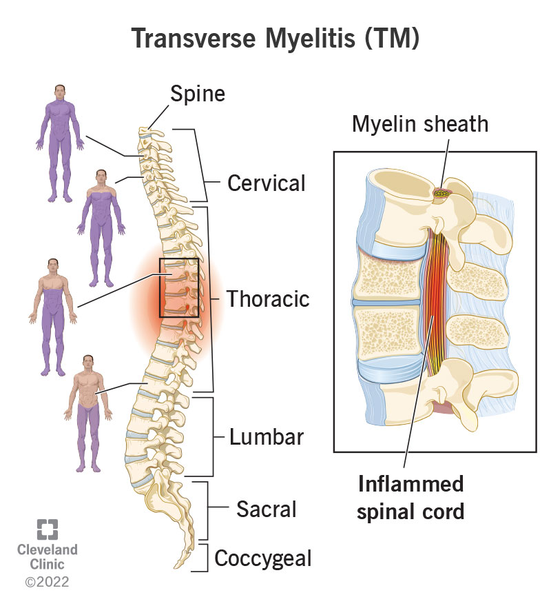 Transverse Myelitis