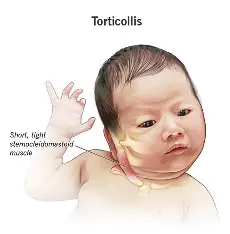Torticollis