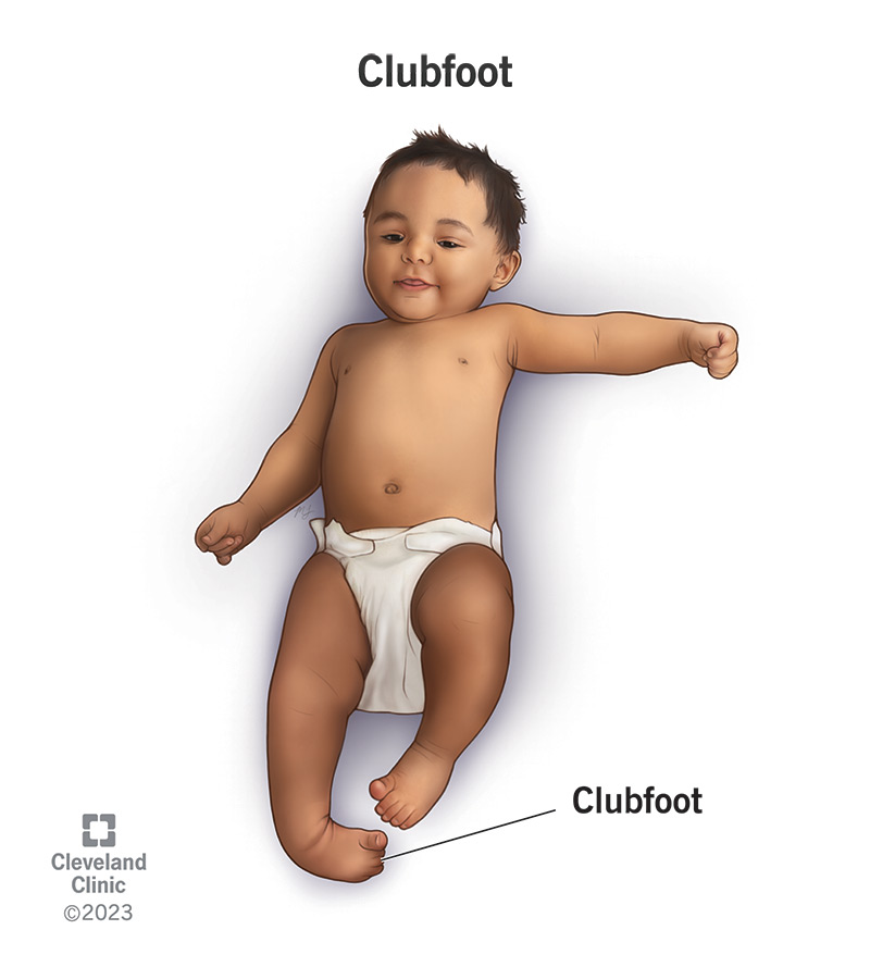 Clubfoot Or Congenital Talipes Equinovarus Or CTEv