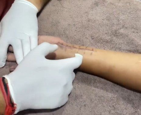 Post Surgical Rehabilitation